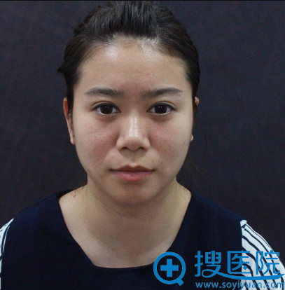 来丽水华美隆鼻术前照片 来丽水华美隆鼻术前照片