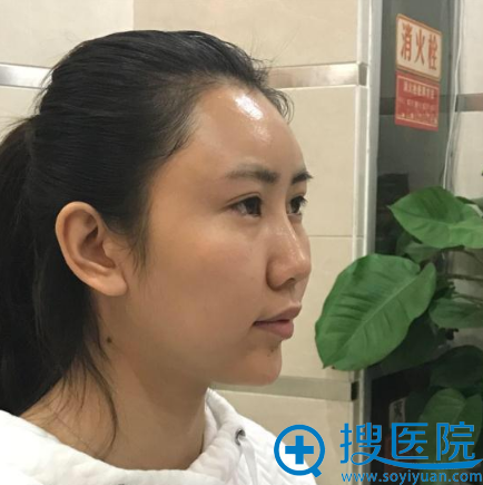 整形老司机告诉你我找西安童颜堂医院王家贵做鼻综合隆鼻的原因