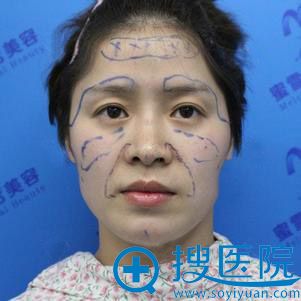 找合肥蜜雪尔许飞院长做了面部脂肪填充后都说我年轻了好几岁