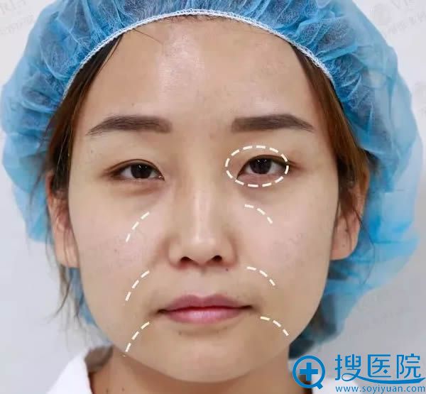 我终于找到端木雪峰主任做了双眼皮和开眼角及全脸自体脂肪填充
