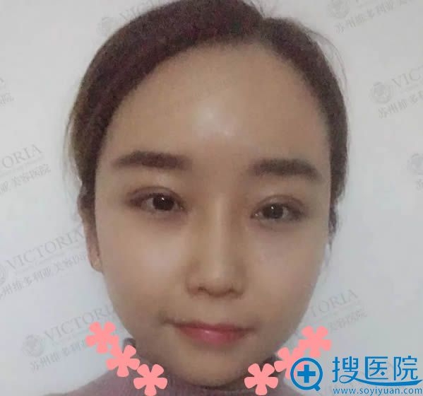 双眼皮和开眼角术后10天的恢复效果 双眼皮和开眼角术后10天的恢复效果