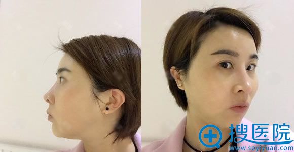 找成都美瑞皮肤向雪岑做过点阵激光这次回美瑞找谷云岗做下巴
