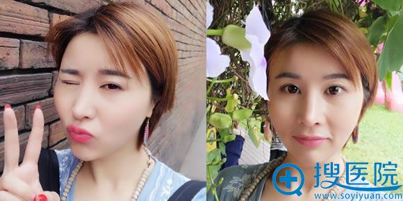 注射玻尿酸丰下巴20天恢复照 注射玻尿酸丰下巴20天恢复照
