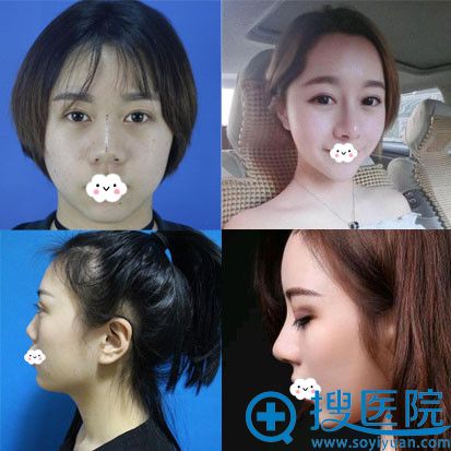 厦门海峡假体隆鼻综整形真人案例效果对比 厦门海峡假体隆鼻综整形真人案例效果对比