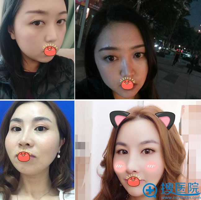 <!--<i data=20240710 data-id=14176></i>-->皮肤整形下巴和案例 <!--<i data=20240710 data-id=14176></i>-->皮肤整形下巴和案例