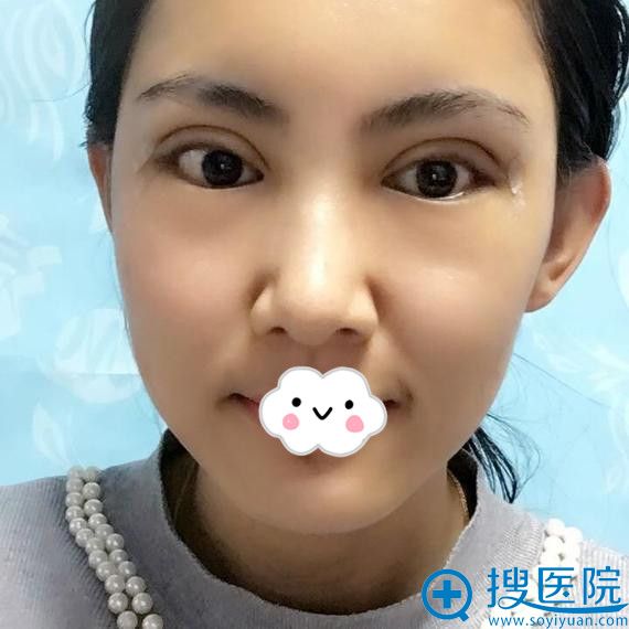 大同清木姜际珠切开双眼皮+开外眼角案例 大同清木姜际珠切开双眼皮+开外眼角案例