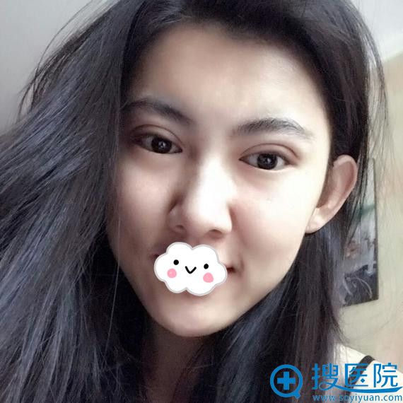 大同清木姜际珠切开双眼皮效果怎么样 大同清木姜际珠切开双眼皮效果怎么样