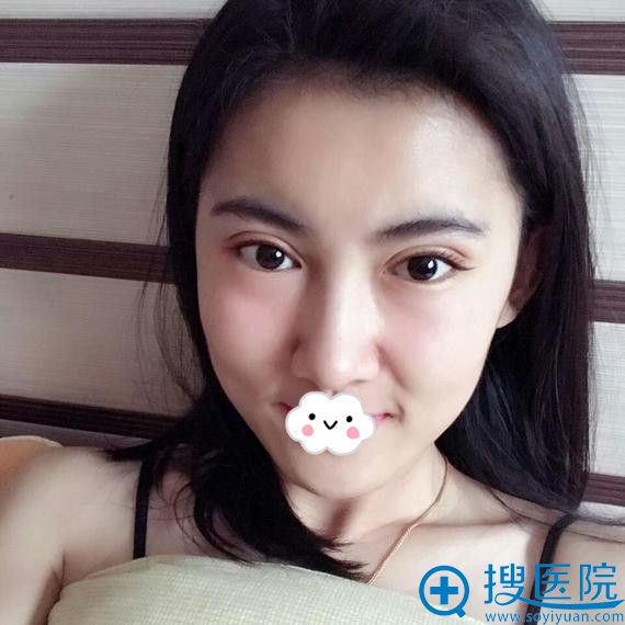 大同双眼皮哪家好?大同清木姜际珠案例 大同双眼皮哪家好?大同清木姜际珠案例