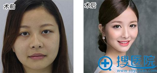 �沿��ƽ���ϣ������ҳ�ɳ��������ӽ�����沿֬�����60��Ч��