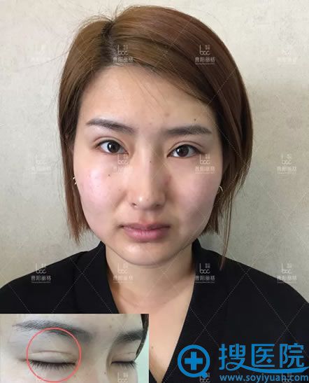找重庆曹阳做双眼皮修复前 找重庆曹阳做双眼皮修复前