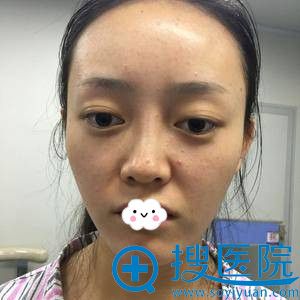 <!--<i data=20240710 data-id=8401></i>-->吉梅斯自体脂肪填充全脸真人案例 <!--<i data=20240710 data-id=8401></i>-->吉梅斯自体脂肪填充全脸真人案例