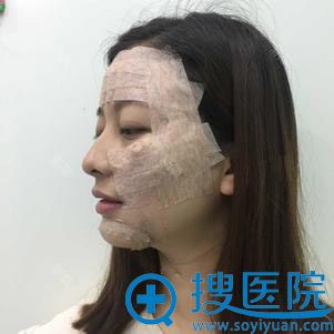 长沙科颜美陈咏玲面部脂肪填充案例 长沙科颜美陈咏玲面部脂肪填充案例