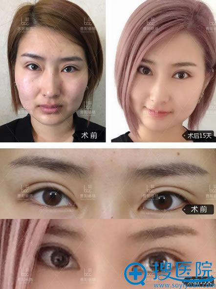 选择重庆曹阳做眼睛15天效果图 选择重庆曹阳做眼睛15天效果图