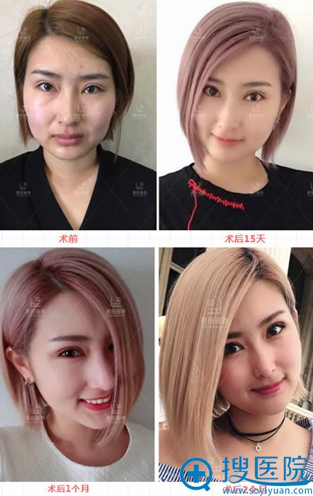 在曹阳丽格做双眼皮修复2个月恢复过程图 在曹阳丽格做双眼皮修复2个月恢复过程图