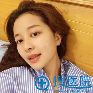 长沙科颜美陈咏玲面部脂肪填充案例 长沙科颜美陈咏玲面部脂肪填充案例