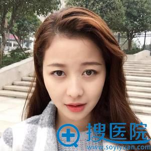 长沙科颜美陈咏玲面部脂肪填充案例 长沙科颜美陈咏玲面部脂肪填充案例