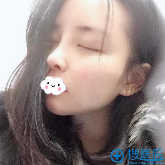 长沙天一鼻整形怎么样?谢磊达拉斯综合隆鼻案例 长沙天一鼻整形怎么样?谢磊达拉斯综合隆鼻案例