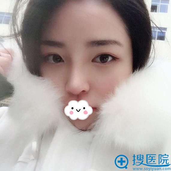 长沙天一谢磊膨体假体隆鼻术后效果怎么样 长沙天一谢磊膨体假体隆鼻术后效果怎么样