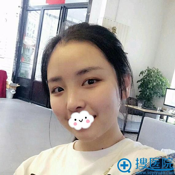 长沙天一假体隆鼻效果好吗?看真人案例 长沙天一假体隆鼻效果好吗?看真人案例