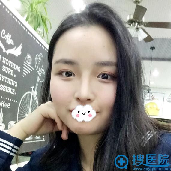 长沙天一假体隆鼻综合整形术后恢复效果 长沙天一假体隆鼻综合整形术后恢复效果