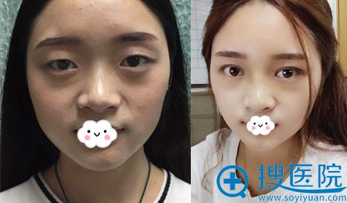 泸州花都双眼皮真人案例效果对比 泸州花都双眼皮真人案例效果对比