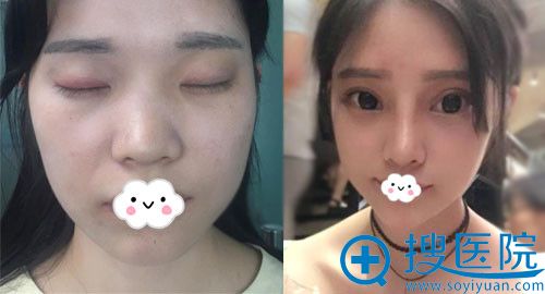 泸州花都假体隆鼻案例效果对比展示 泸州花都假体隆鼻案例效果对比展示