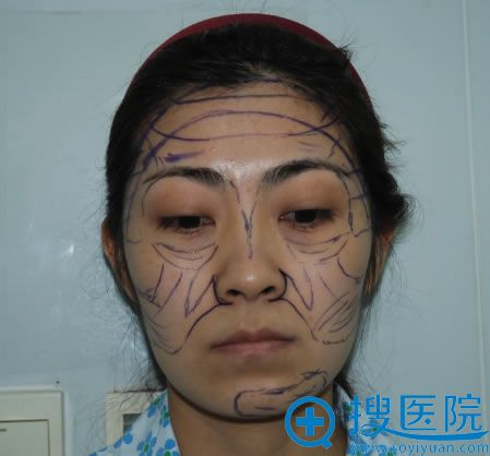 北京乔爱军自体脂肪填充方案 北京乔爱军自体脂肪填充方案