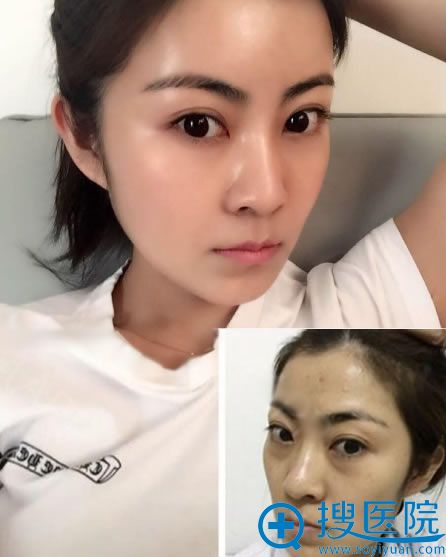 北京乔爱军脂肪填充案例对比图 北京乔爱军脂肪填充案例对比图