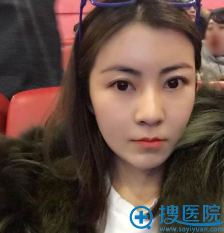 找北京乔爱军做面部填充3个月效果 找北京乔爱军做面部填充3个月效果