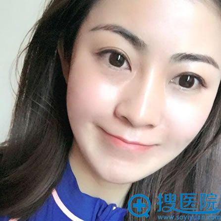 选择北京乔爱军做脂肪填充半年后 选择北京乔爱军做脂肪填充半年后