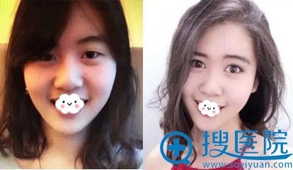 <!--<i data=20240710 data-id=8537></i>-->双眼皮真人案例效果对比 <!--<i data=20240710 data-id=8537></i>-->双眼皮真人案例效果对比