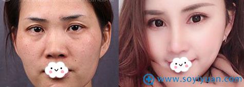 <!--<i data=20240710 data-id=8537></i>-->隆鼻效果好吗?脂肪填充+鼻综合+眼综合整形对比: <!--<i data=20240710 data-id=8537></i>-->隆鼻效果好吗?脂肪填充+鼻综合+眼综合整形对比: