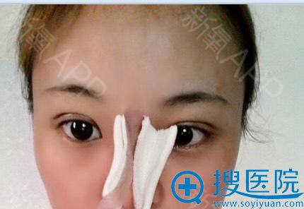 遂宁阳光丽人魏恒双眼皮效果怎么样 遂宁阳光丽人魏恒双眼皮效果怎么样