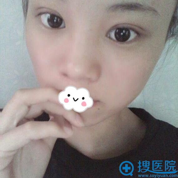 遂宁双眼皮哪家好?遂宁阳光丽人真人案例 遂宁双眼皮哪家好?遂宁阳光丽人真人案例