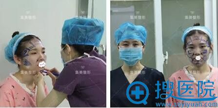 郑州集美王一星自体脂肪丰面恢复效果图片 郑州集美王一星自体脂肪丰面恢复效果图片