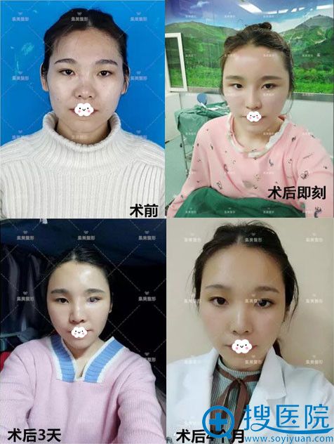 郑州集美王一星自体脂肪面部填充案例效果好吗 郑州集美王一星自体脂肪面部填充案例效果好吗