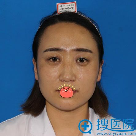 面诊保定丽都和京都整形医院后选择京都刘建刚院长做面部线雕