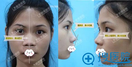 想要预见未知美到深圳丽港丽格做谢氏假体鼻综合改变