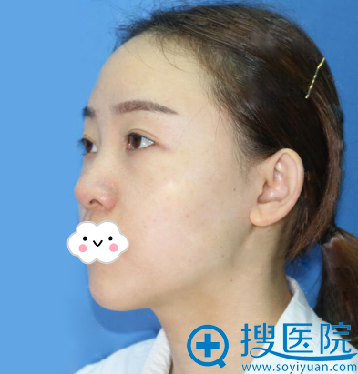 花6W多到深圳江南春天做自体肋软骨隆鼻综合+脂肪丰苹果肌挺值