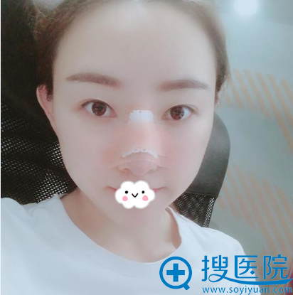 深圳江南春天蓝剑雄自体肋软骨隆鼻效果怎么样 深圳江南春天蓝剑雄自体肋软骨隆鼻效果怎么样