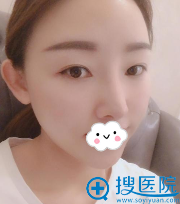 深圳江南春天鼻综合+自体脂肪丰苹果肌案例图 深圳江南春天鼻综合+自体脂肪丰苹果肌案例图