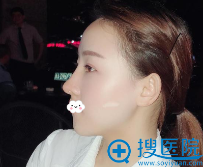 深圳江南春天自体肋软骨隆鼻综合整形案例图片 深圳江南春天自体肋软骨隆鼻综合整形案例图片