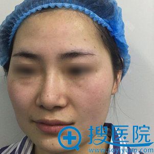 朋友问我变漂亮的秘诀就是我去郑州元素美学做了面部脂肪填充