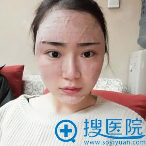 <!--<i data=20240710 data-id=9131></i>-->整形面部脂肪填充案例 <!--<i data=20240710 data-id=9131></i>-->整形面部脂肪填充案例