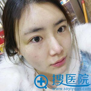 <!--<i data=20240710 data-id=9131></i>-->整形面部脂肪填充案例 <!--<i data=20240710 data-id=9131></i>-->整形面部脂肪填充案例