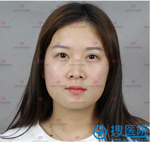 对比了烟台华美和华怡整形医院的案例后找聂瑞峰做了鼻综合隆鼻