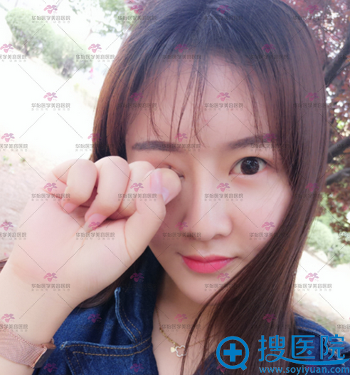 烟台华怡整形医院聂瑞峰医生隆鼻案例术后图片 烟台华怡整形医院聂瑞峰医生隆鼻案例术后图片