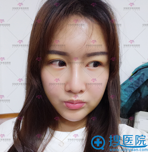 烟台华怡整形医院隆鼻和自体脂肪填充术后十天 烟台华怡整形医院隆鼻和自体脂肪填充术后十天