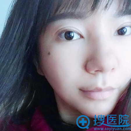 杭州瑞丽整形医院自体脂肪填充术后一周效果 杭州瑞丽整形医院自体脂肪填充术后一周效果