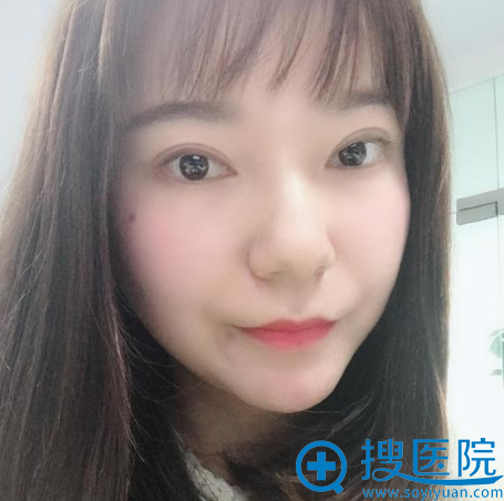 杭州瑞丽整形医院自体脂肪填充术后半个月图片 杭州瑞丽整形医院自体脂肪填充术后半个月图片